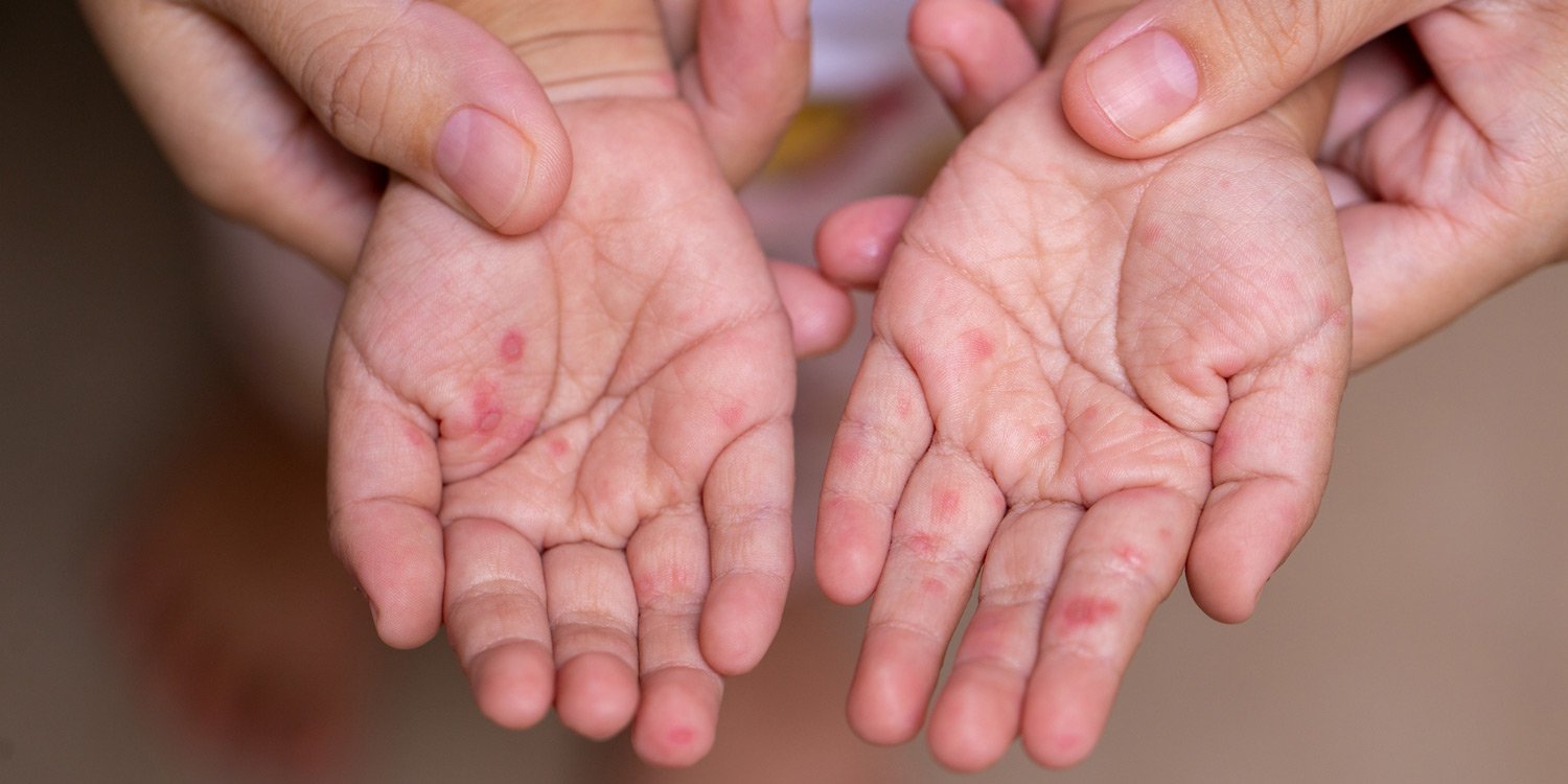 Hand-foot-and-mouth disease